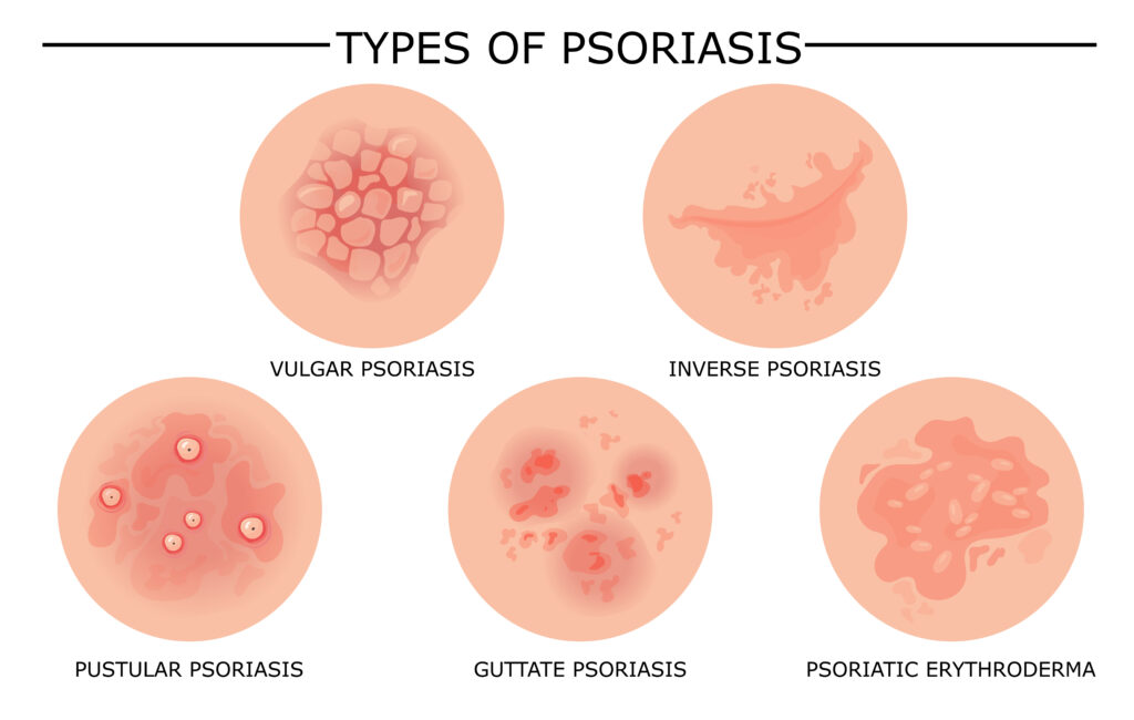 Illustrative diagram showcasing different types of psoriasis