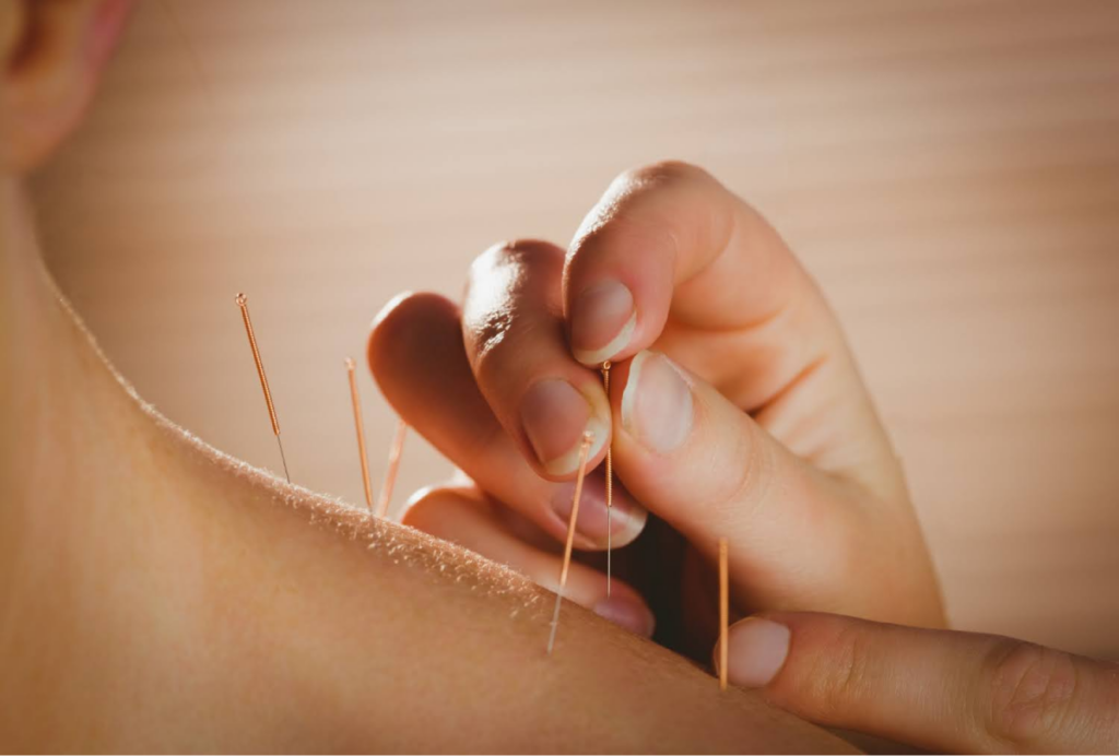 Close-up of acupuncture needles being applied to a patient's neck.